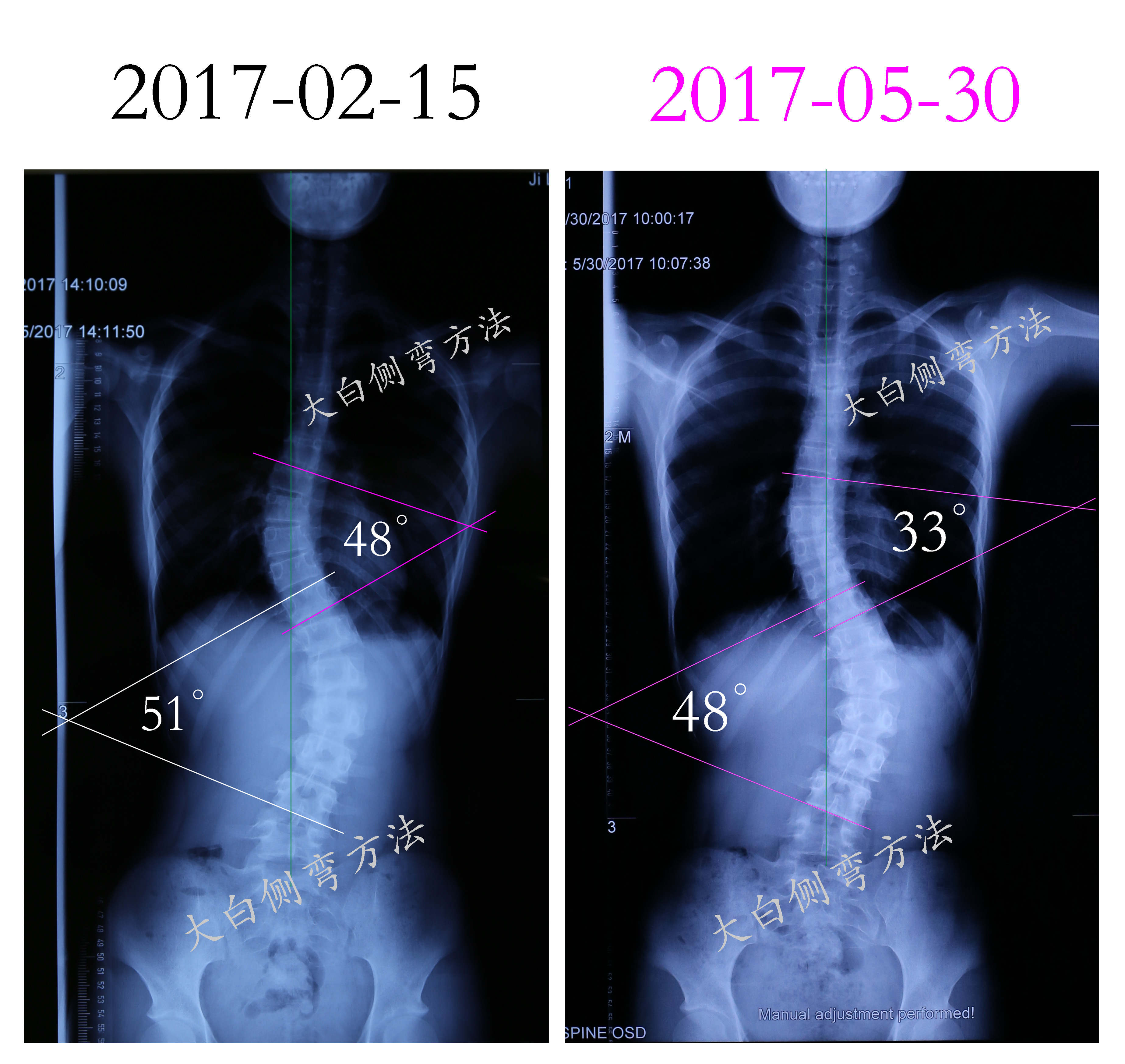 家长必看！关于脊柱侧弯，这些事你必须知道 - 知乎