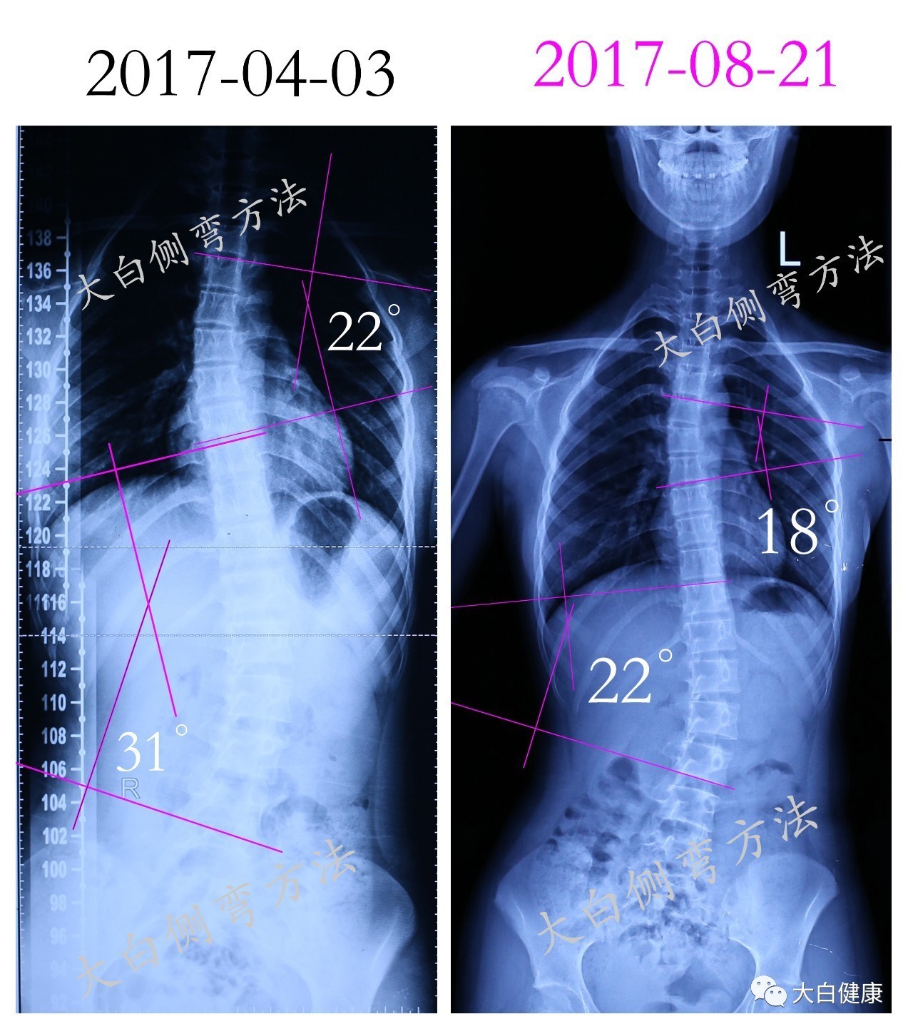 康睿仕案例分享： 13岁脊柱侧弯15度，康复训练15次矫正10度恢复__凤凰网