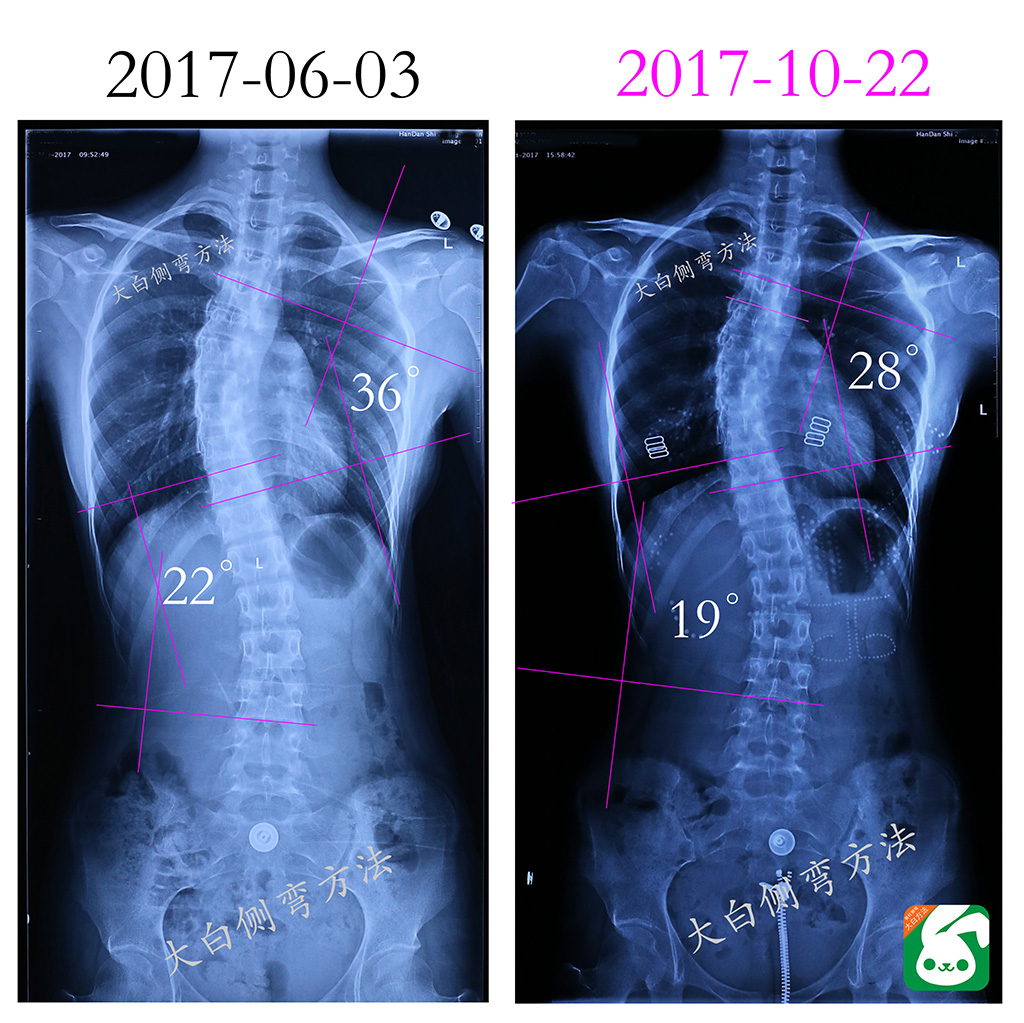 女孩脊柱侧弯21度，治疗1年后，度数成功减少10度！ - 知乎