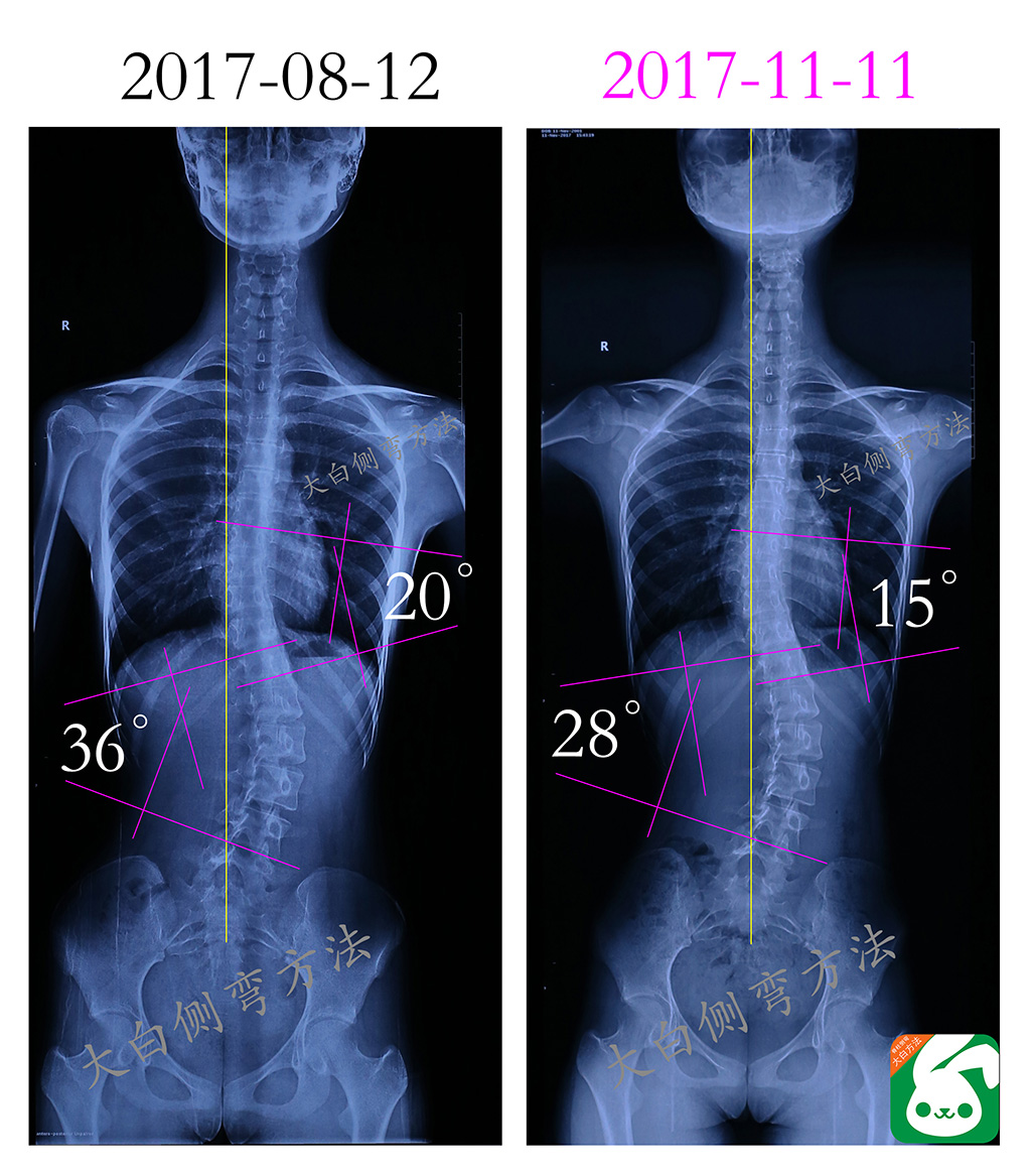 孩子得了脊柱侧凸，究竟该不该做手术？|月经来潮|青少年|脊柱|-健康界